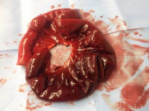 occlusion intestinale